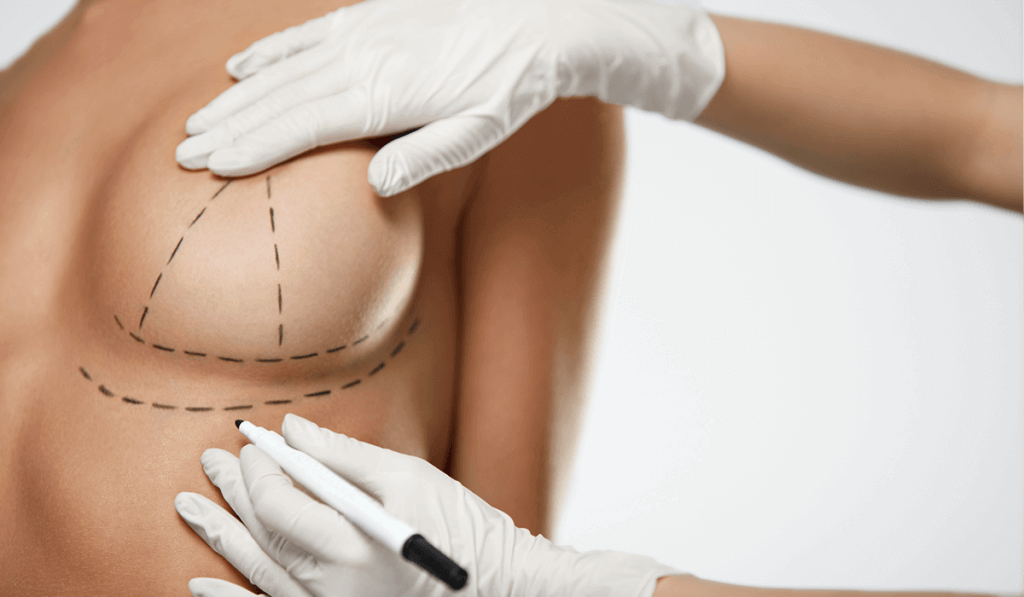 Non-Surgical Breast Lift: Love Your Breasts - Belcourt Aesthetics